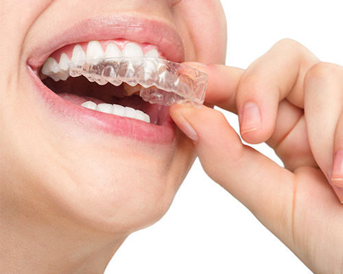 Clear Aligners